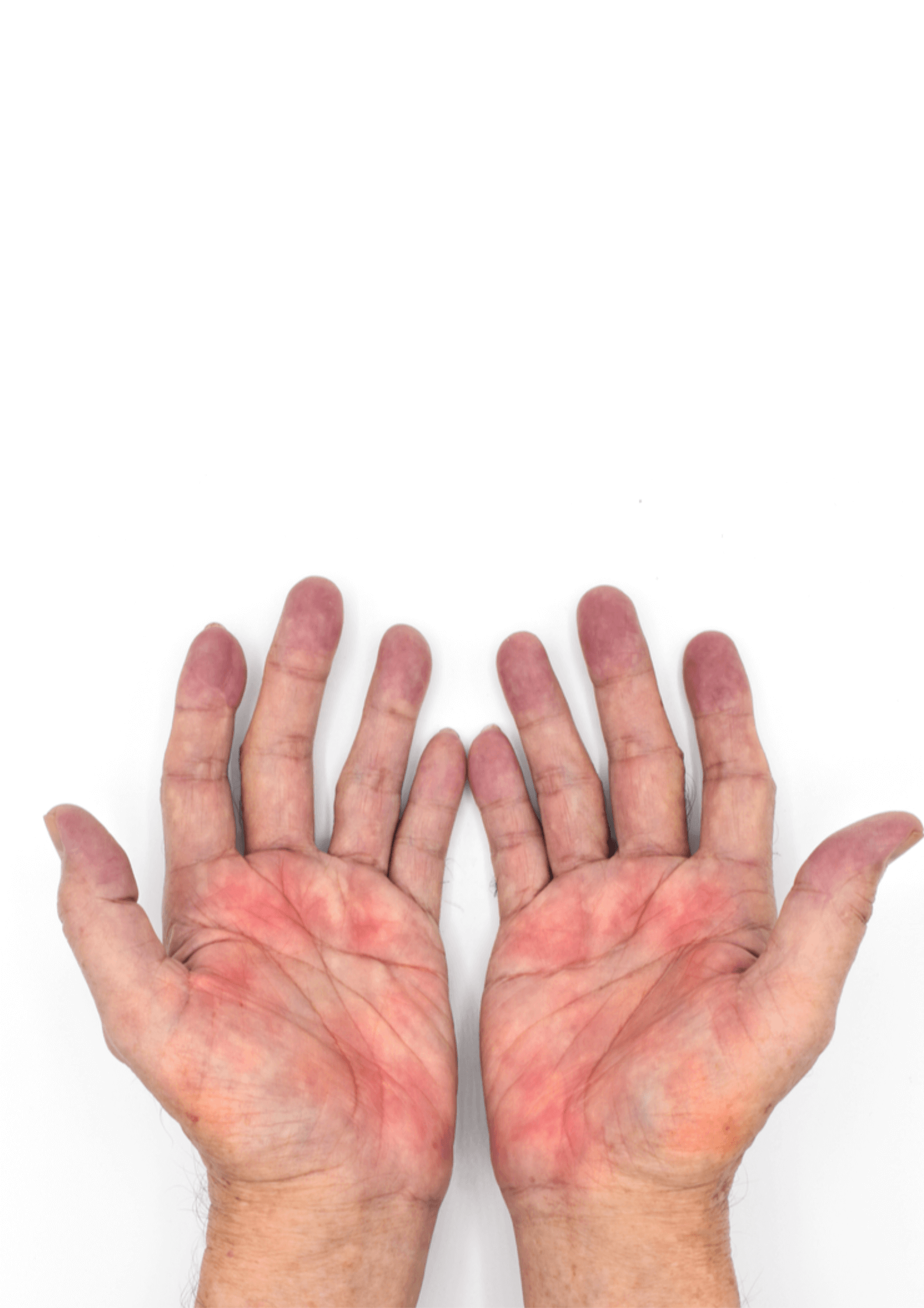 Crevasses aux mains- quel traitement pour quel symptôme